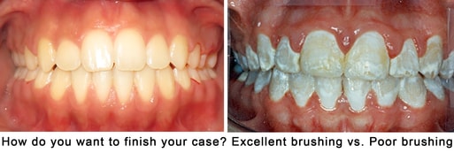 Brushing With Braces