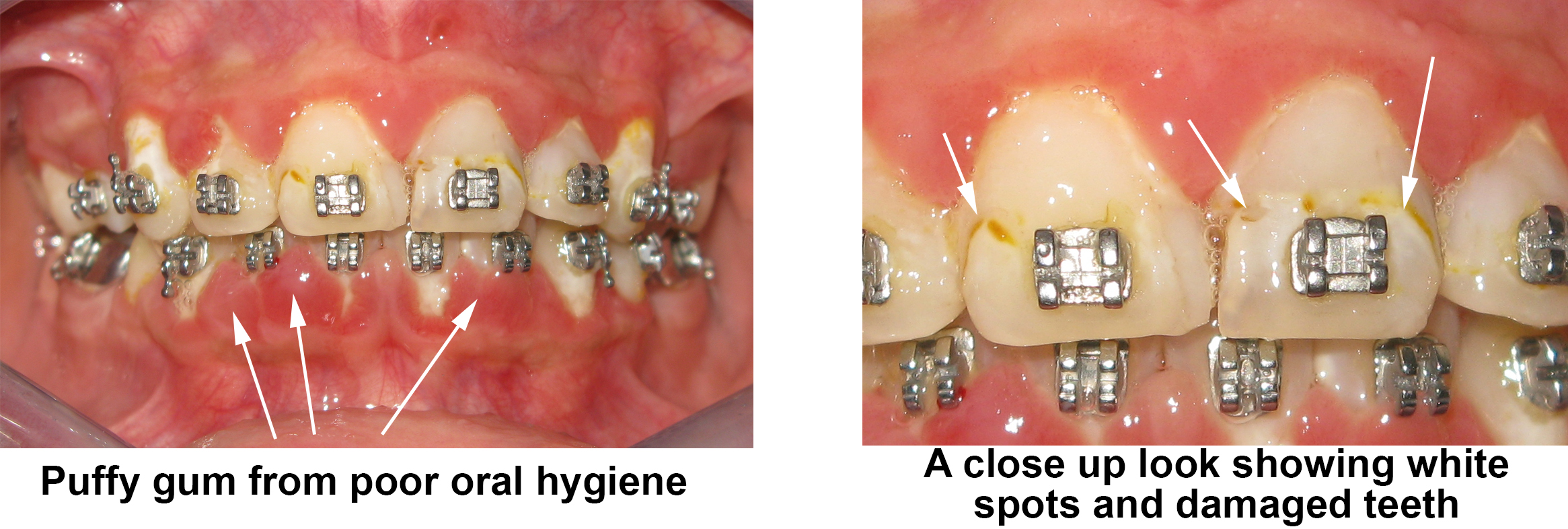 What happened if you do not brush your teeth with braces