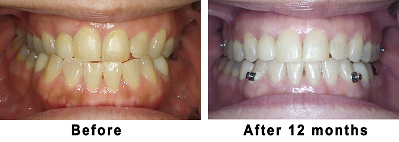Before Invisalign underbite correction in Houston 