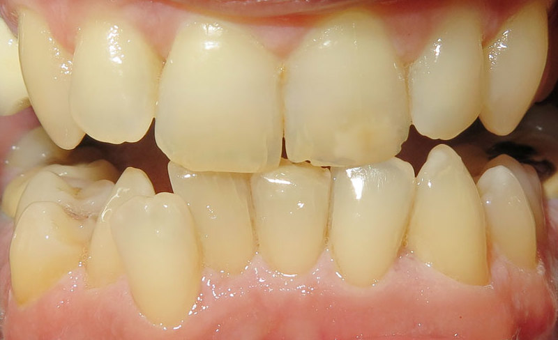 Crowding with hard access to clean teeth