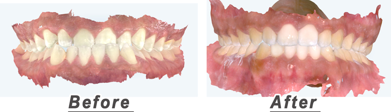 Before and After Invisalign underbite correction in Houston 