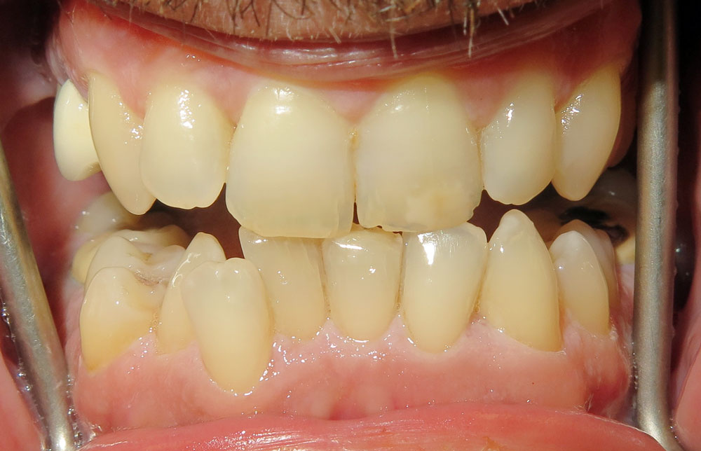 Crowding with hard access to clean teeth