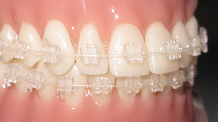 Clear Braces in Houston