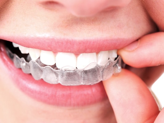 CLEAR BRACES – Welcome To Lana's Dental Care (239) 593-6488