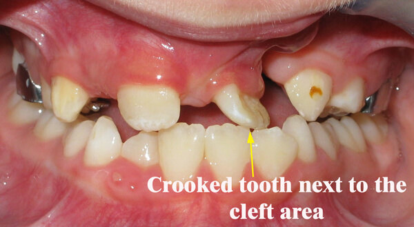 crooked teeth with cleft palate Houston Texas