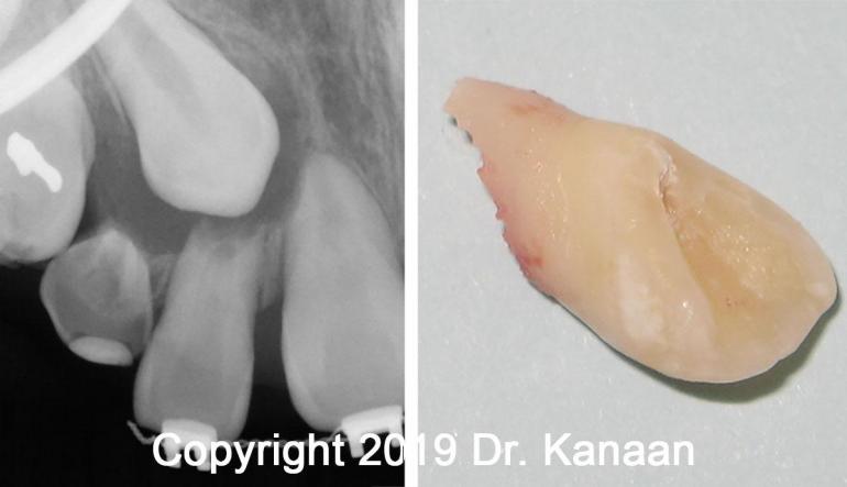 tooth from impact