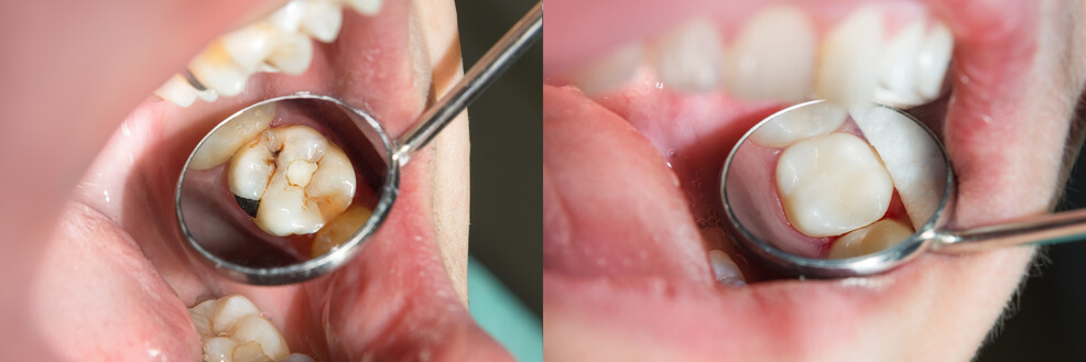 Dental Crown Procedure