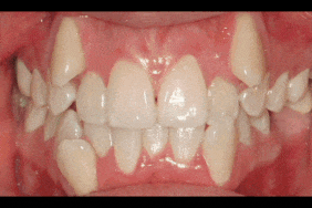 Before and after Orthodontic treatment