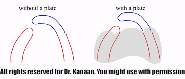 Plate importnat effect in CLP patient