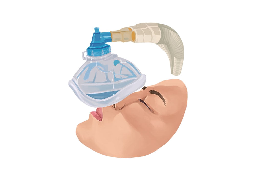 General Anesthesia