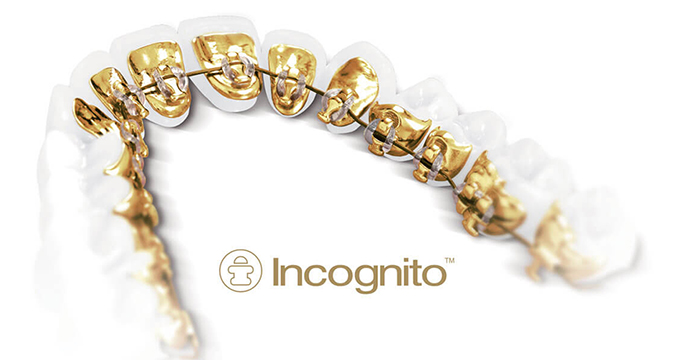 Lingual Braces Incognito Sugar Land Houston TX 77478