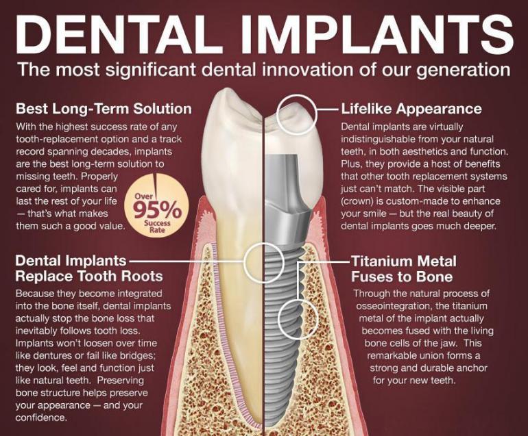 Dental Implant Info Graphic