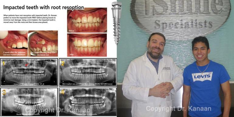 impacted canine correction with mini implants