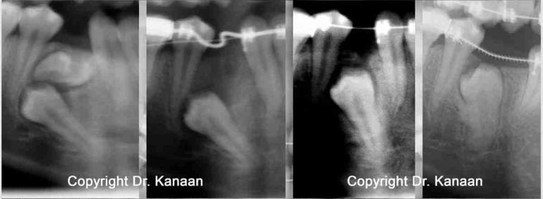 impacted premolar self correction