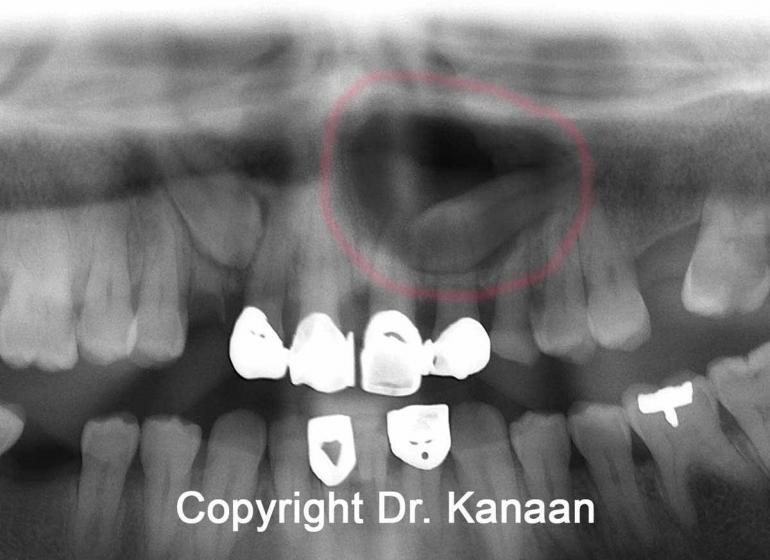 Impacted tooth cyst 