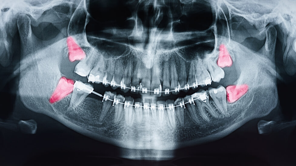 Impacted Wisdom Tooth