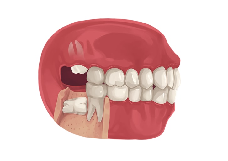 https://www.ismilespecialists.com/sites/default/files/inline-images/impacted-wisdom-tooth.jpg