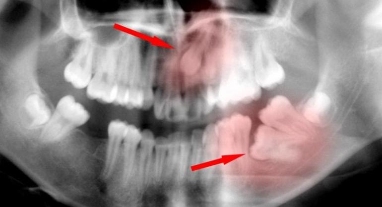 Impacted Canine 