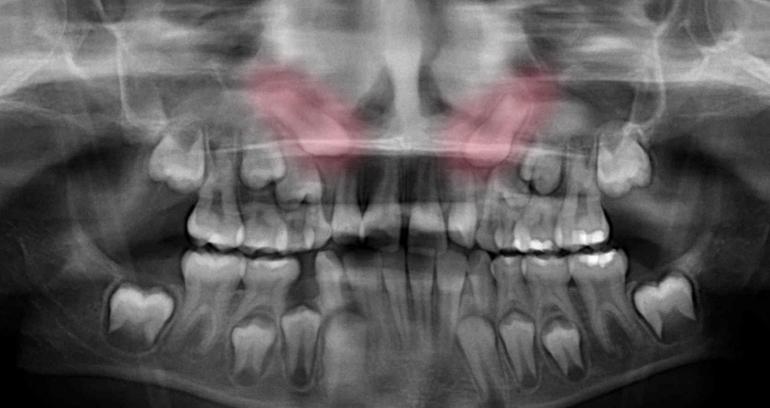 Impacted Canine Narrow