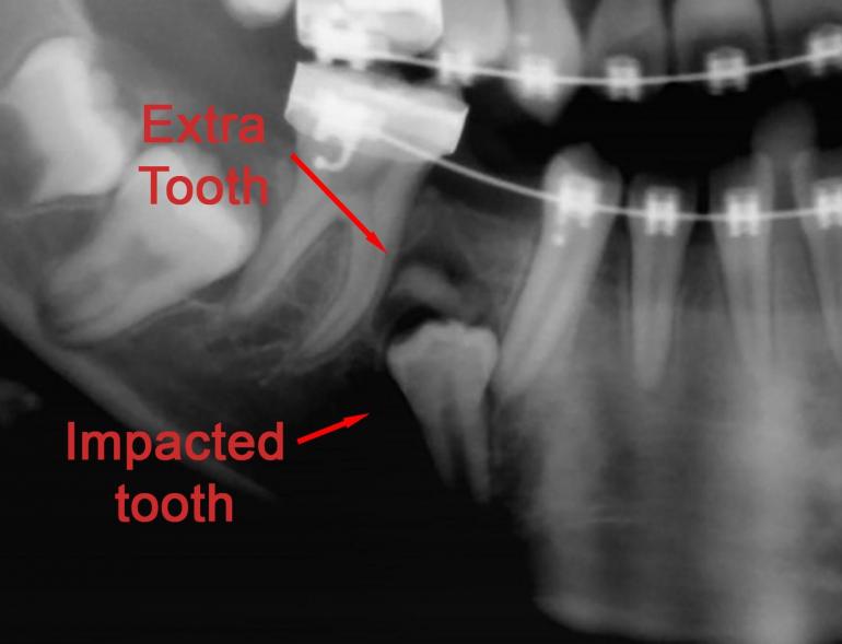 Impacted Premolar