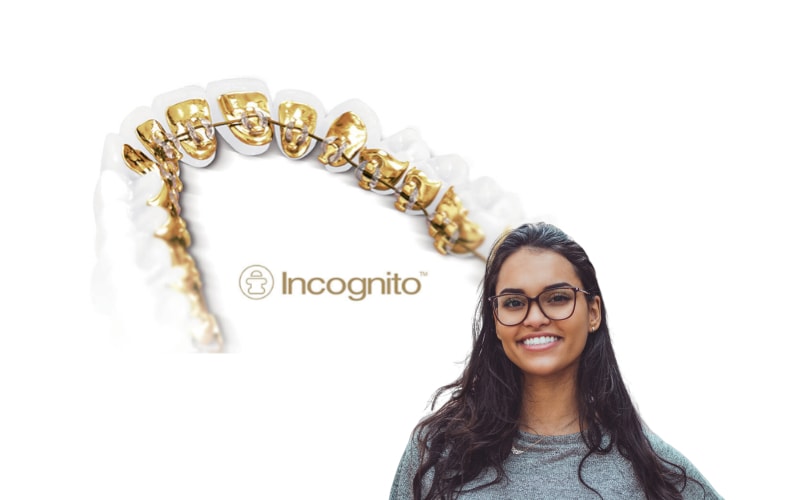 lingual incognito braces