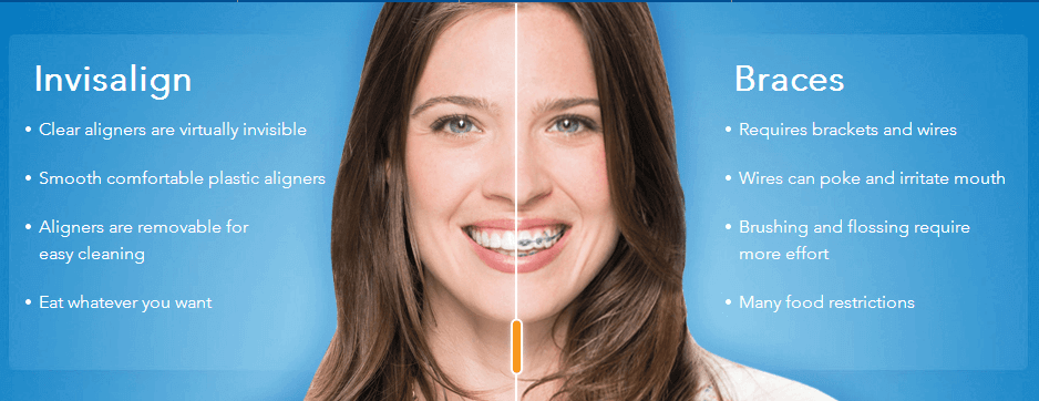 invisalign vs braces