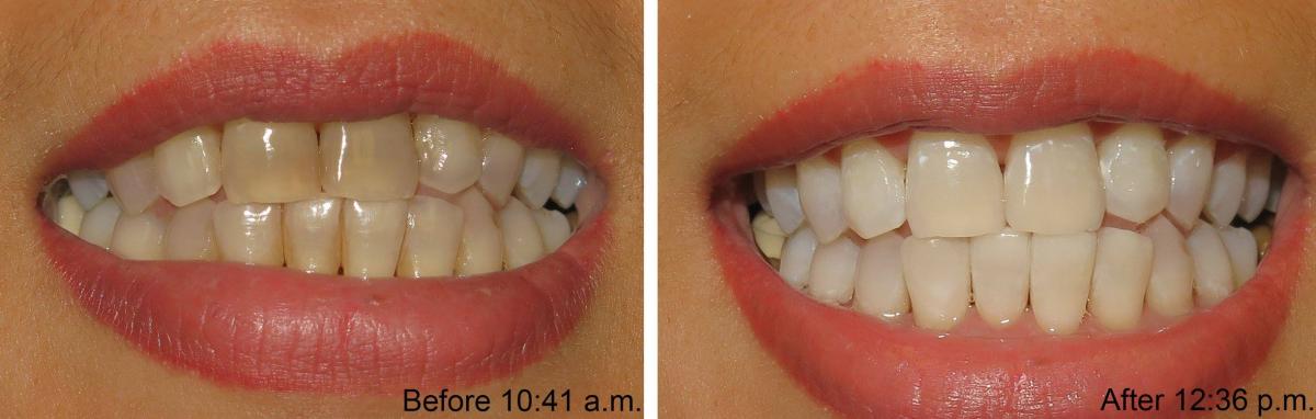 Zoom Whitening Patient