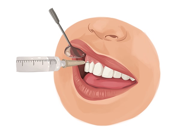 local-anesthesia