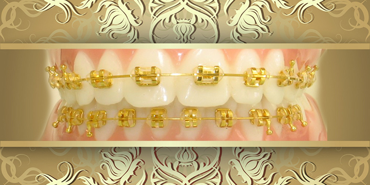 Luxury Gold braces Sugar Land Houston