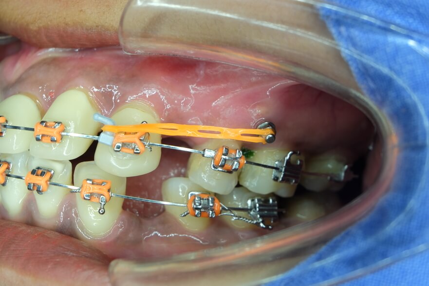 dental mini implants