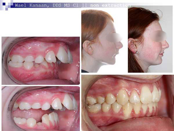 Jaw Surgery for Underbite, Overbite, Crossbite, Bad Bite - Cleft