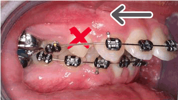 Over jet correction with Braces