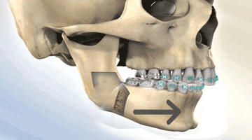 over bite correction with surgery