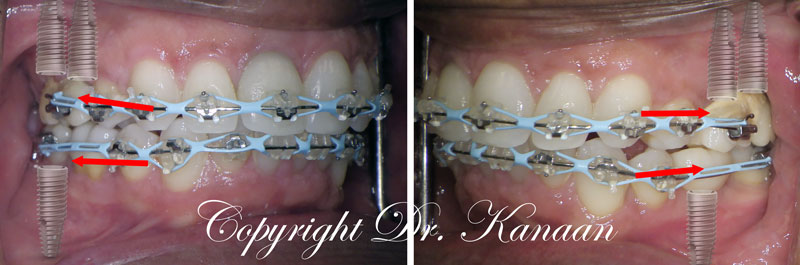 Second step adult overbite correction with implants