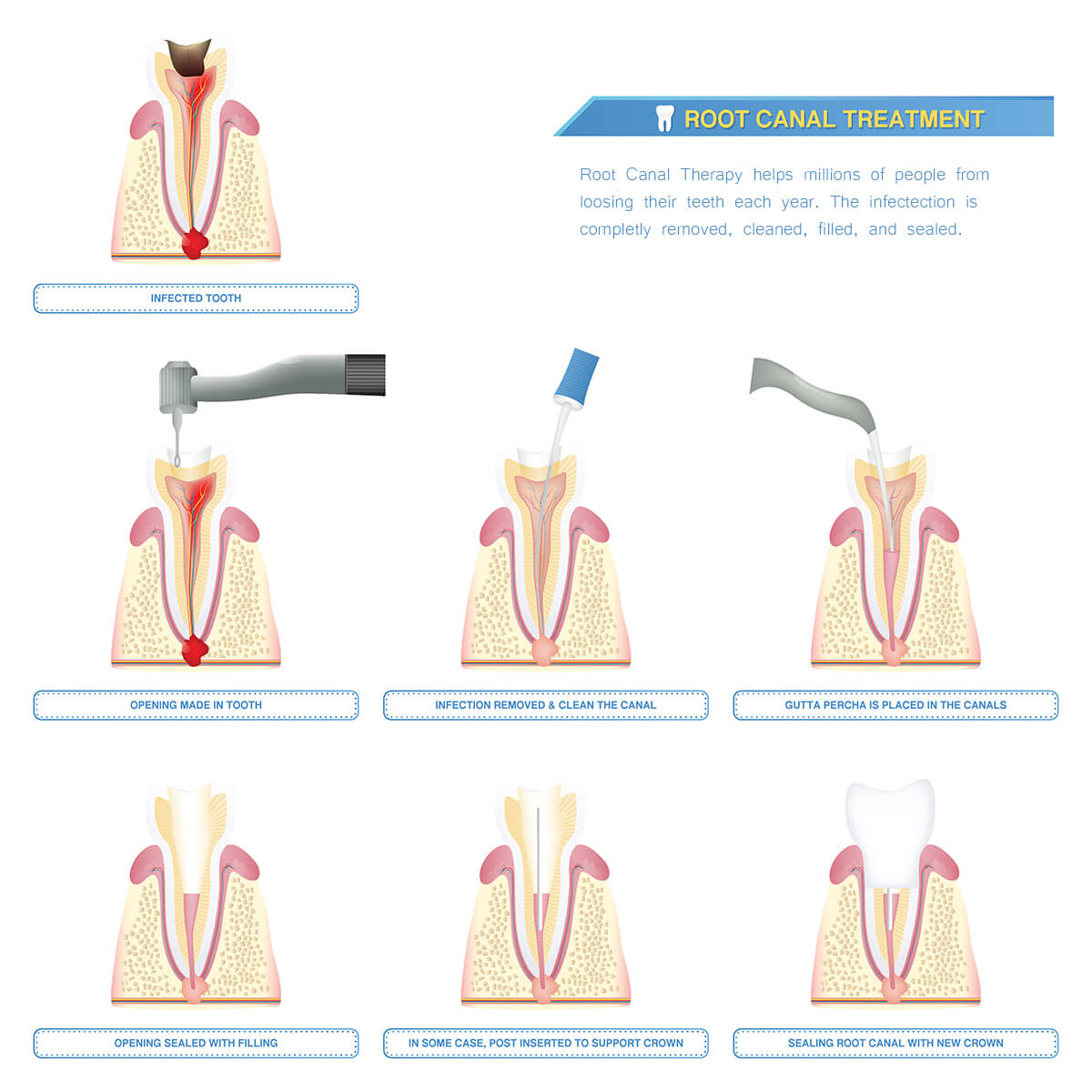 Root Canal Treatment