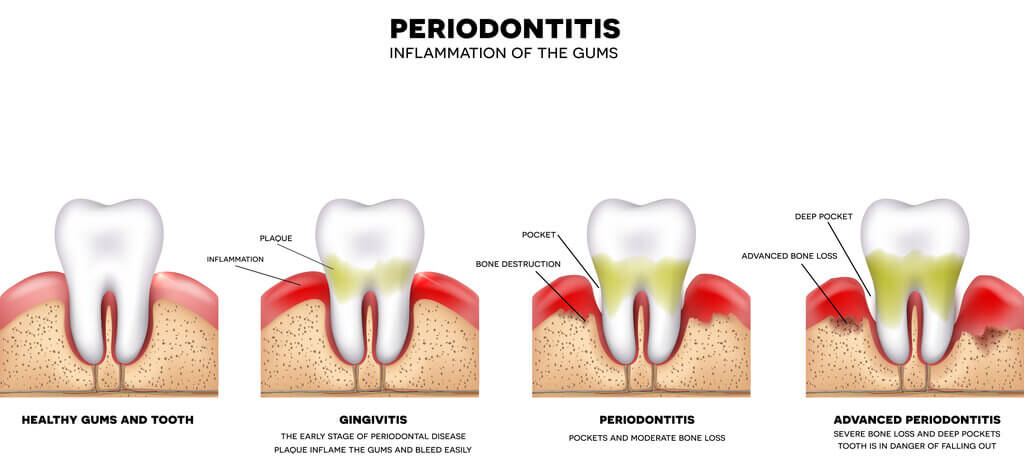 Advanced bone loss due to gum disease