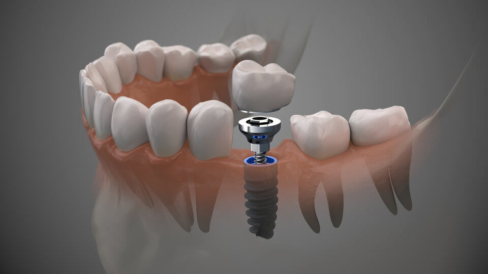 Dental Implant fusing to bone