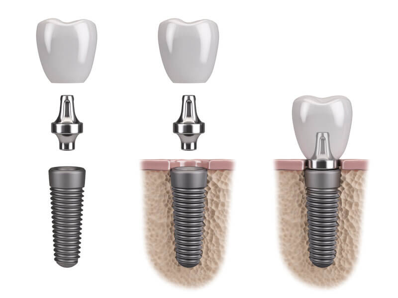 Dental Implants Sugar Land
