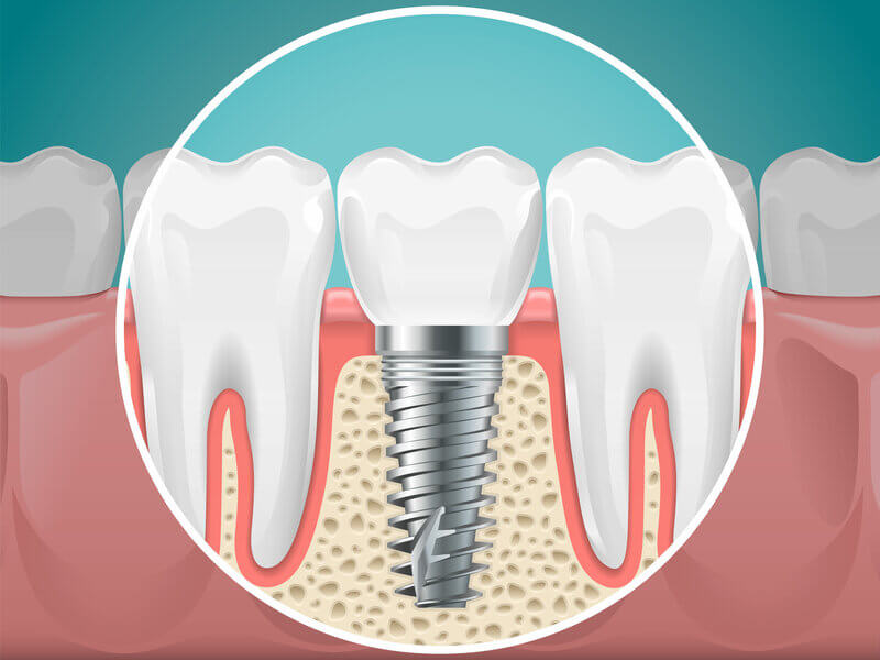 Dental Implant In Bone