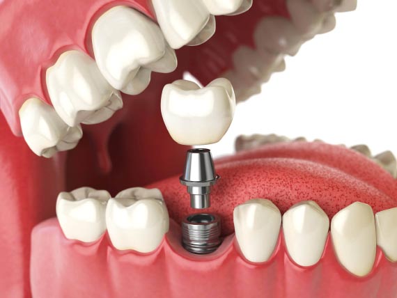 Dental Implants