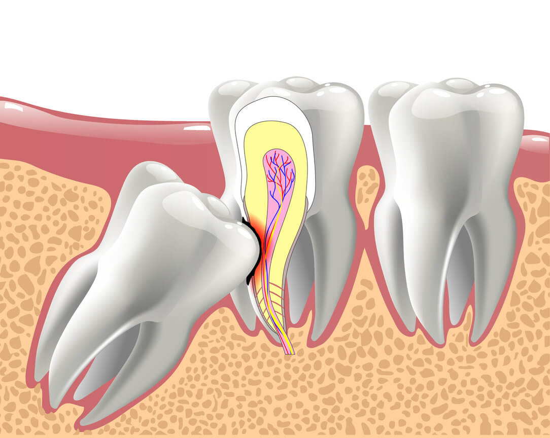 impacted-wisdom-tooth