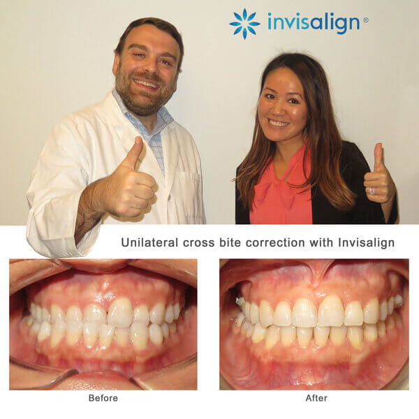 Invisalign Dentists Case