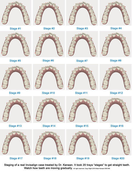 How Invisalign Moves Your Teeth