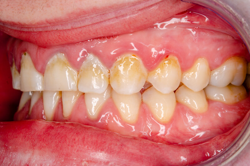 Dental Deep Cleaning