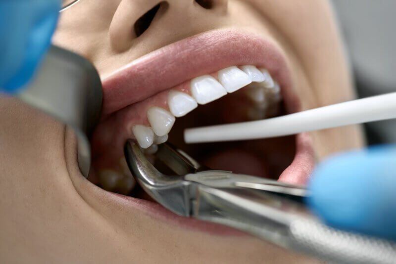 tooth extraction houston