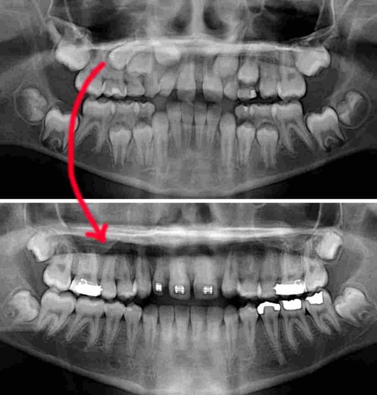 Self Correcting Impacted Canine