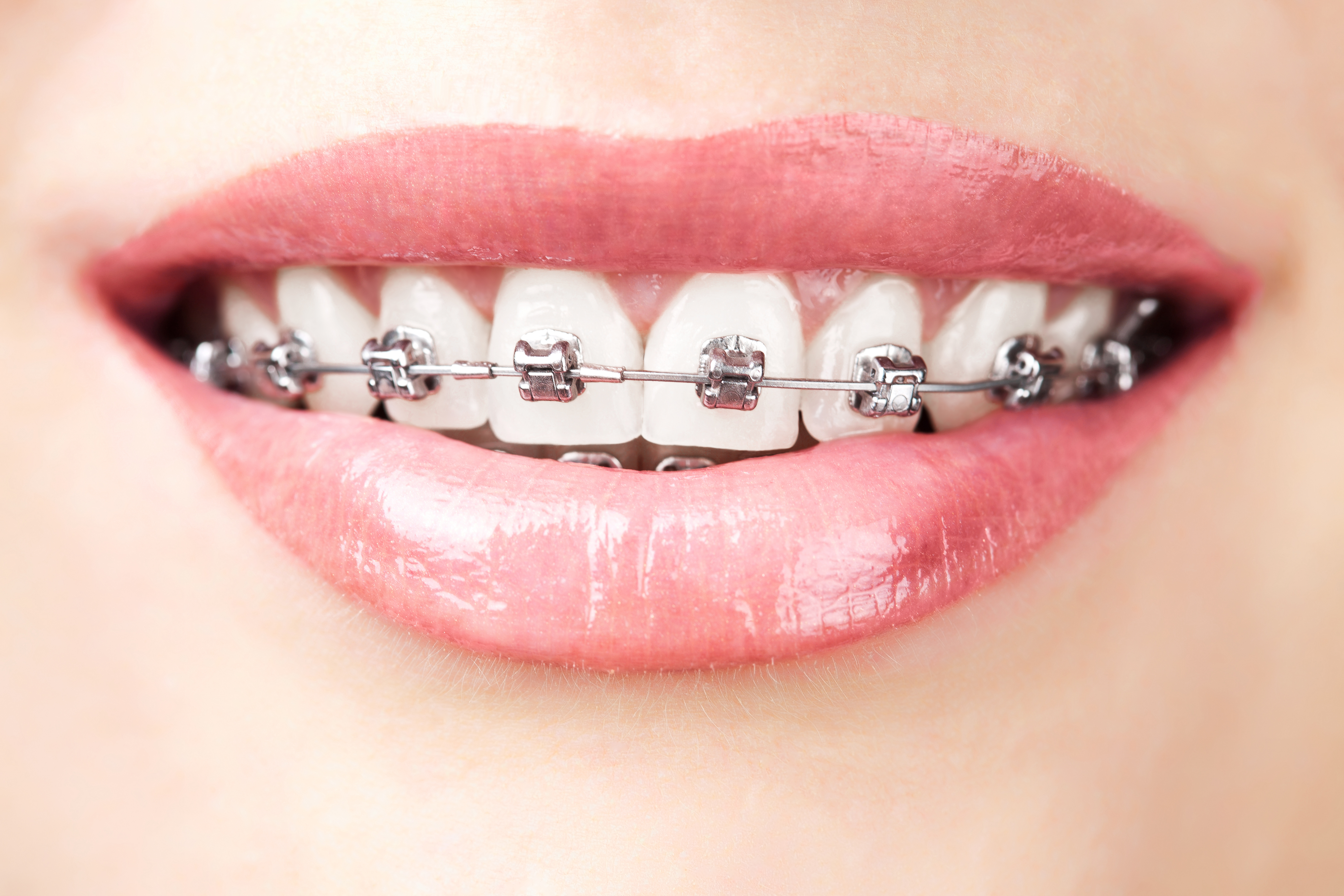 woman smiling with traditional metal braces