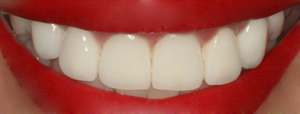 Porcelain Dental Veneers