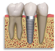 Affordable Dental Implants Houston