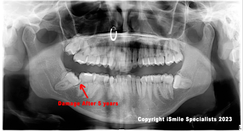 wisdom teeth case number 2